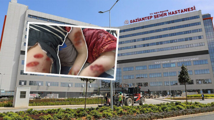 2024 01 sanliurfada kopekler saldirmisti tedavisi gaziantepte suruyor scaled