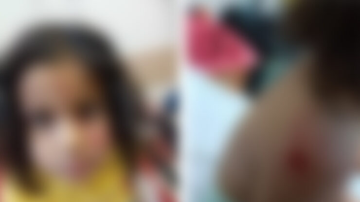 2024 06 viransehirde sokak kopeklerinin saldirdigi cocuk yaralandi scaled